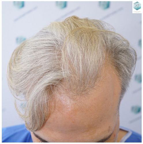 Injerto Capilar Técnica FUE 2803 Grafts (6691 pelos) 1 injerto capilar valencia