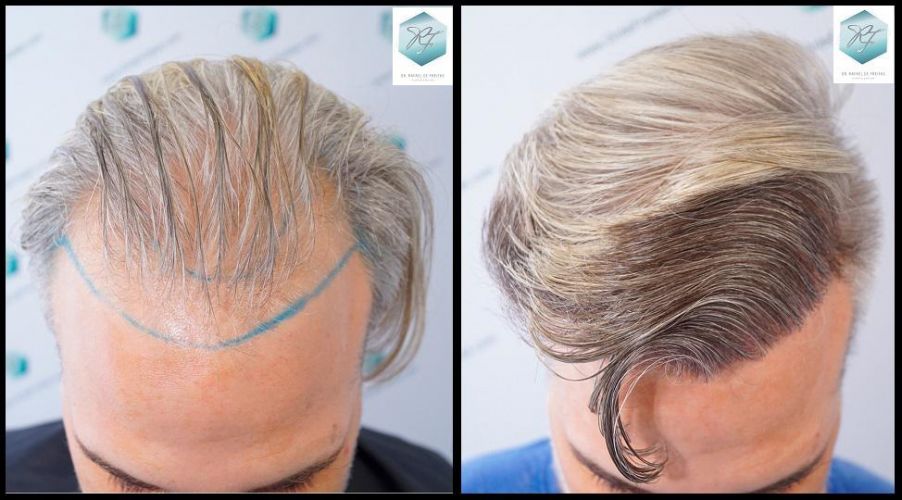 Injerto Capilar Técnica FUE 2803 Grafts (6691 pelos) 41 Antes y después implante capilar FUE