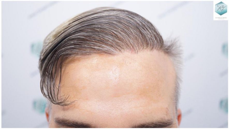 Injerto Capilar Técnica FUE 2803 Grafts (6691 pelos) 24 Resultados injerto capilar