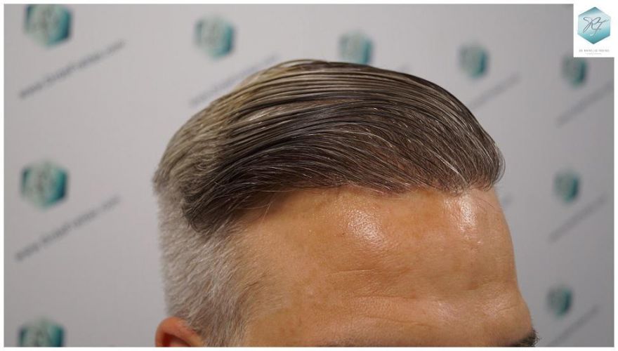 Injerto Capilar Técnica FUE 2803 Grafts (6691 pelos) 25 Resultados injerto capilar