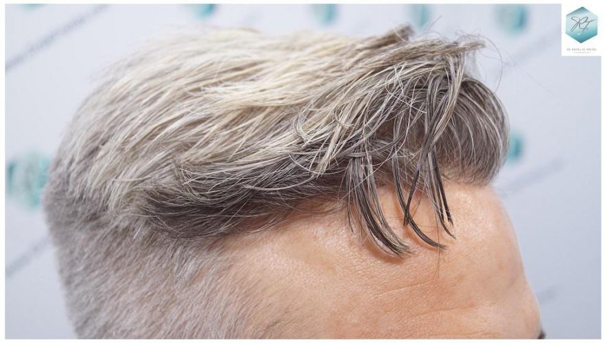 Injerto Capilar Técnica FUE 2803 Grafts (6691 pelos) 27 Resultados injerto capilar