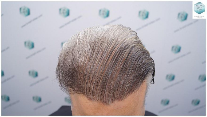 Injerto Capilar Técnica FUE 2803 Grafts (6691 pelos) 28 Resultados injerto capilar