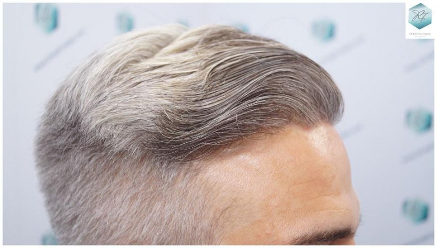 Injerto Capilar Técnica FUE 2803 Grafts (6691 pelos) 30 Resultados reales trasplante capilar
