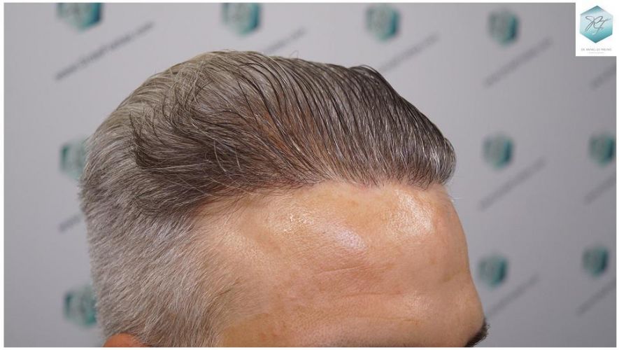Injerto Capilar Técnica FUE 2803 Grafts (6691 pelos) 31 Resultados reales trasplante capilar