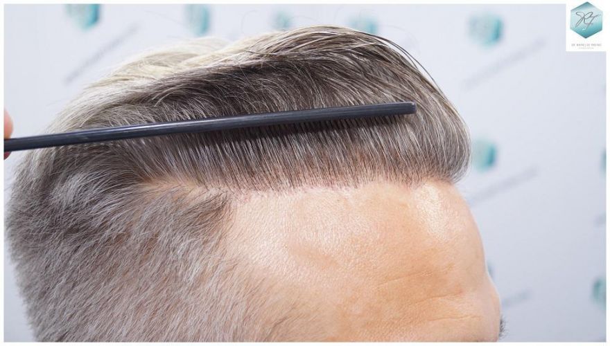 Injerto Capilar Técnica FUE 2803 Grafts (6691 pelos) 32 Resultados reales trasplante capilar