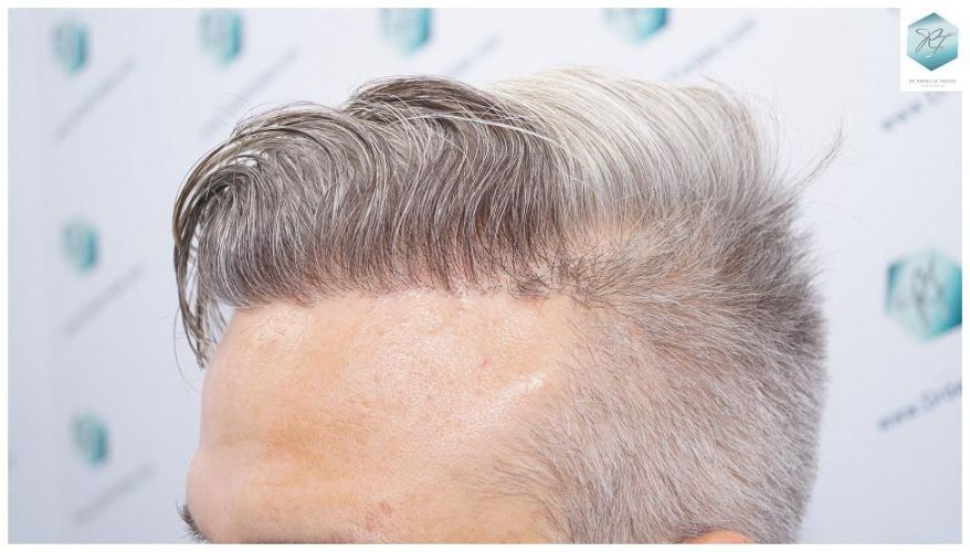 Injerto Capilar Técnica FUE 2803 Grafts (6691 pelos) 33 Resultados reales trasplante capilar