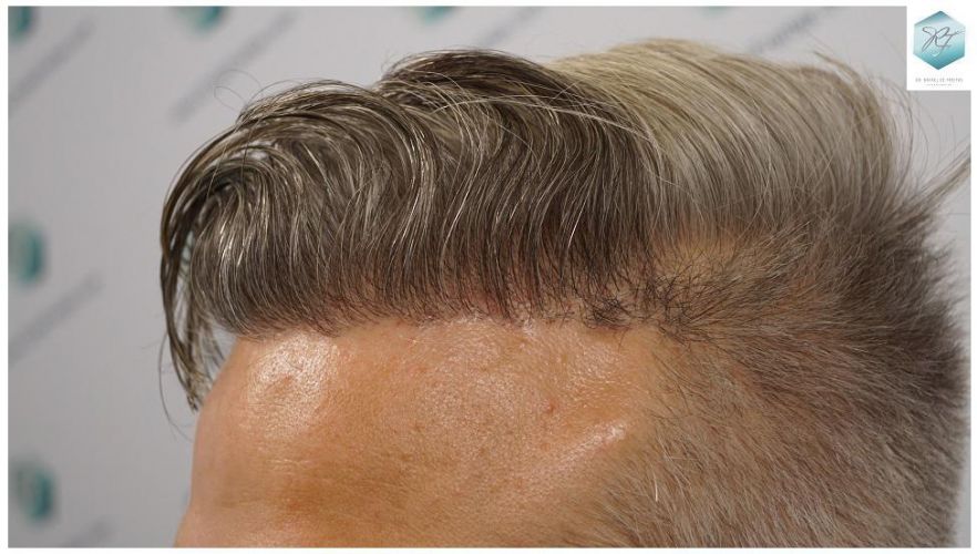 Injerto Capilar Técnica FUE 2803 Grafts (6691 pelos) 19 Resultados injerto capilar