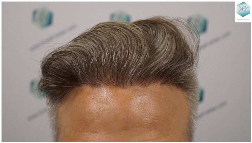 Injerto Capilar Técnica FUE 2803 Grafts (6691 pelos) 34 Resultados reales trasplante capilar