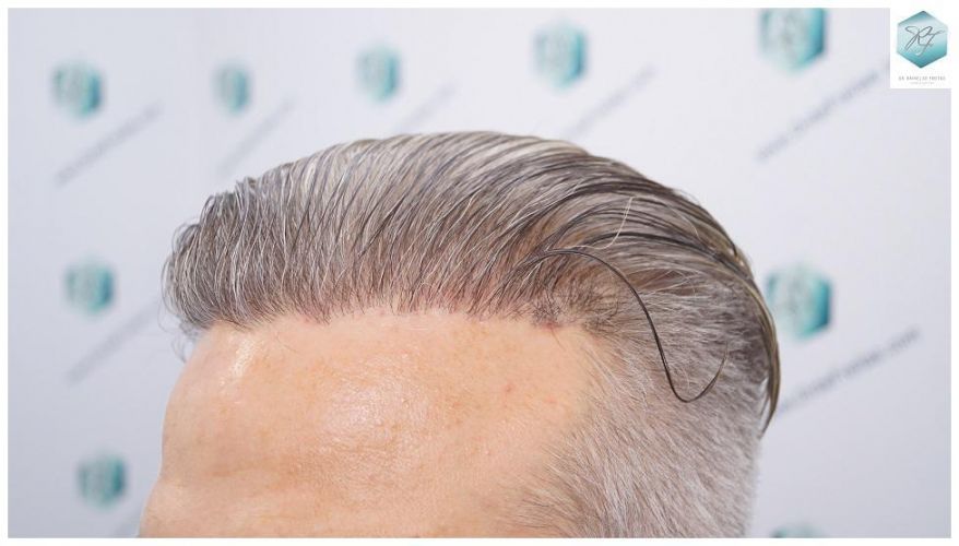 Injerto Capilar Técnica FUE 2803 Grafts (6691 pelos) 35 Resultados reales trasplante capilar