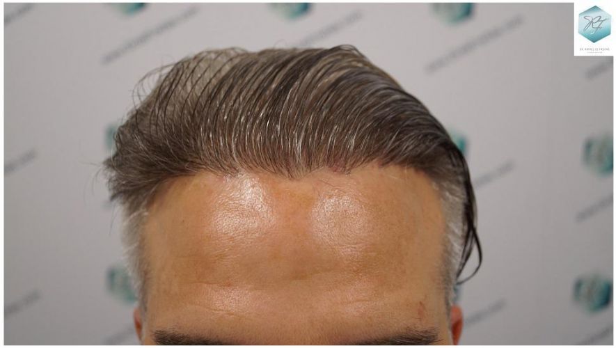 Injerto Capilar Técnica FUE 2803 Grafts (6691 pelos) 36 Tecnica FUE en España