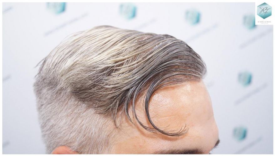 Injerto Capilar Técnica FUE 2803 Grafts (6691 pelos) 37 Tecnica FUE en España