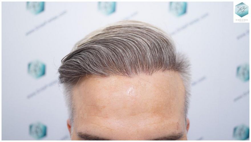 Injerto Capilar Técnica FUE 2803 Grafts (6691 pelos) 38 Tecnica FUE en España