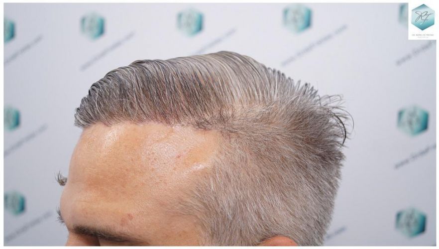 Injerto Capilar Técnica FUE 2803 Grafts (6691 pelos) 21 Tecnica FUE en España