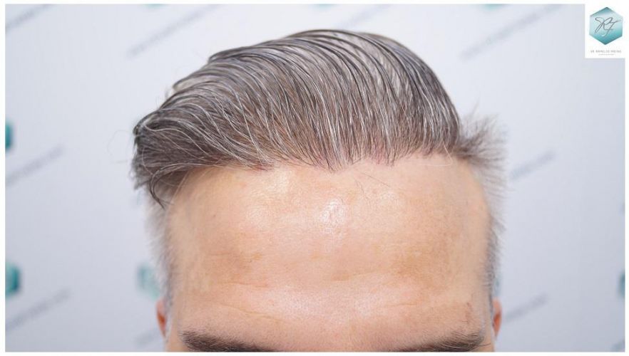 Injerto Capilar Técnica FUE 2803 Grafts (6691 pelos) 15 Resultados injerto capilar