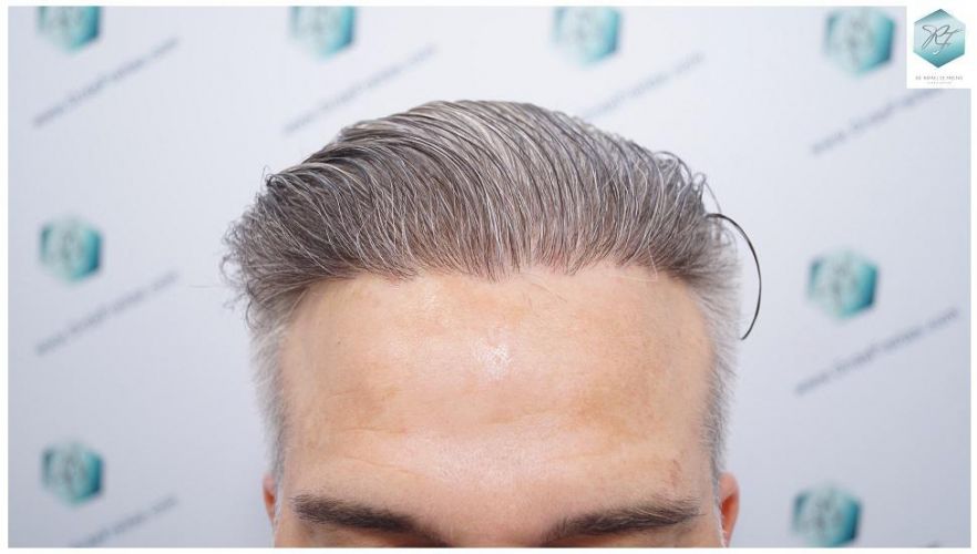 Injerto Capilar Técnica FUE 2803 Grafts (6691 pelos) 16 Resultados injerto capilar