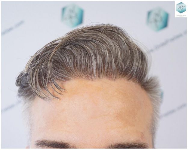 Injerto Capilar Técnica FUE 2803 Grafts (6691 pelos) 17 Resultados injerto capilar