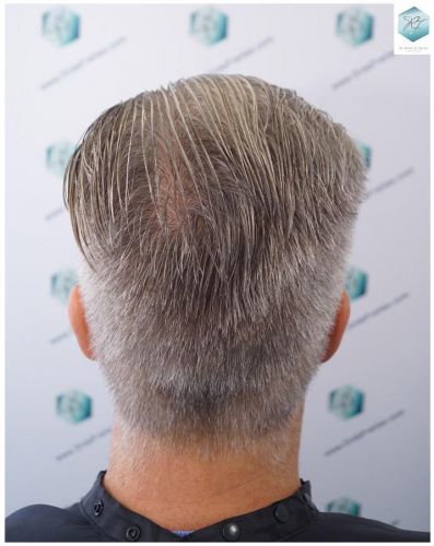Injerto Capilar Técnica FUE 2803 Grafts (6691 pelos) 20 Resultados injerto capilar