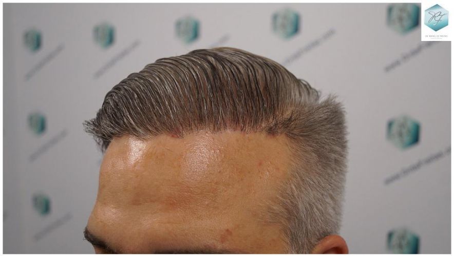 Injerto Capilar Técnica FUE 2803 Grafts (6691 pelos) 22 Resultados injerto capilar