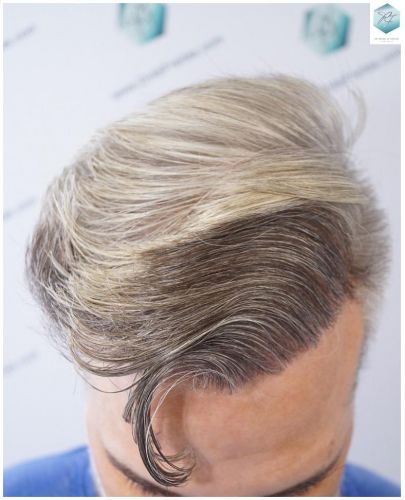 Injerto Capilar Técnica FUE 2803 Grafts (6691 pelos) 18 clínicas de implantes de pelo en Valencia