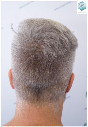 Injerto Capilar Técnica FUE 2803 Grafts (6691 pelos) 23 Resultados injerto capilar