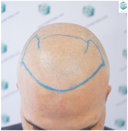 Injerto Capilar Técnica FUE 2803 Grafts (6691 pelos) 8 injerto capilar valencia