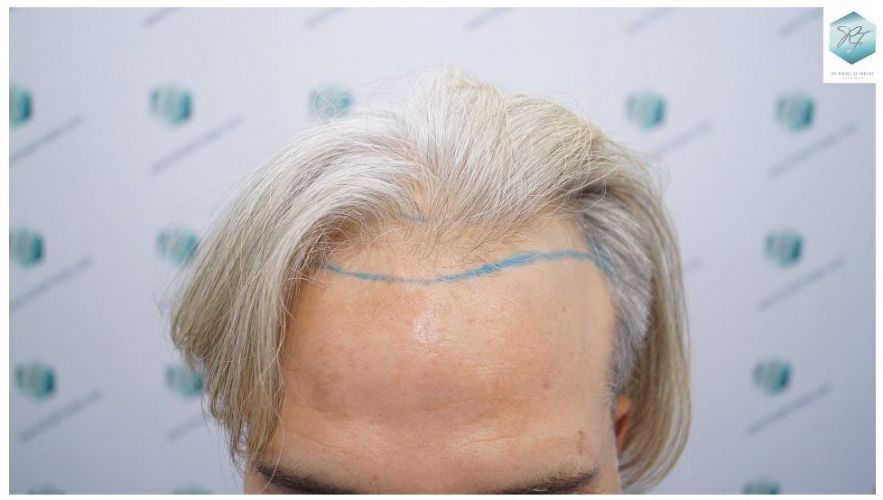 DISEÑO LÍNEA INJERTO CAPILAR Resultados trasplante capilar