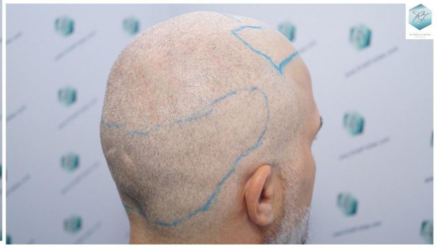 Injerto Capilar Técnica FUE 2803 Grafts (6691 pelos) 9 Resultados trasplante capilar