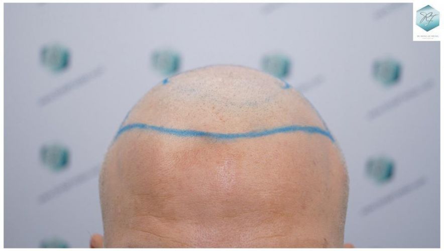 Injerto Capilar Técnica FUE 2803 Grafts (6691 pelos) 7 Resultados trasplante capilar