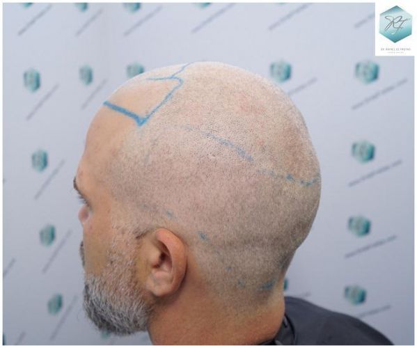 Injerto Capilar Técnica FUE 2803 Grafts (6691 pelos) 10 Resultados trasplante capilar