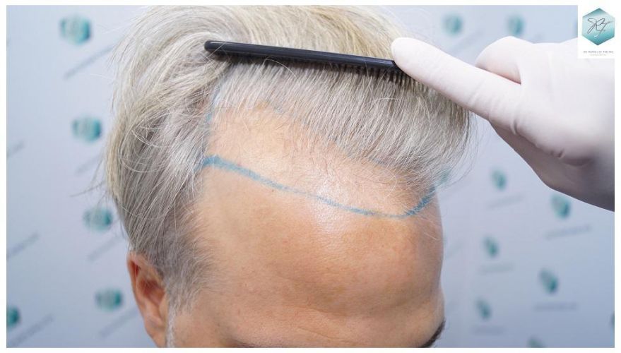 Injerto Capilar Técnica FUE 2803 Grafts (6691 pelos) 6 Resultados trasplante capilar