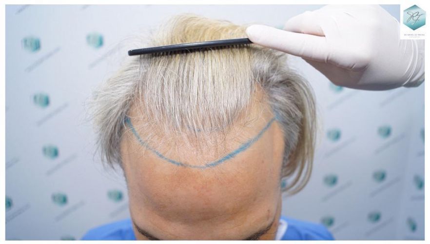 Injerto Capilar Técnica FUE 2803 Grafts (6691 pelos) 5 Resultados trasplante capilar