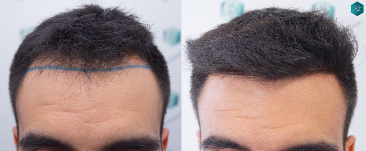 casos reales implante de pelo