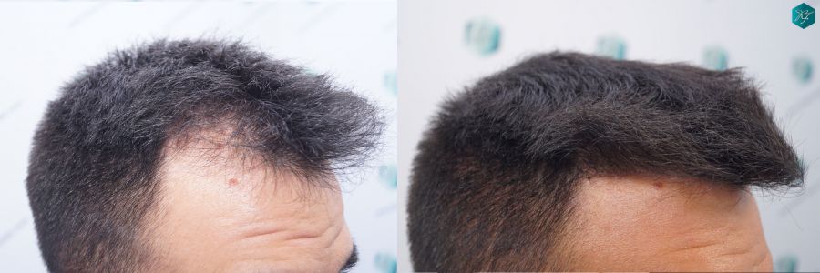 casos reales implante de pelo