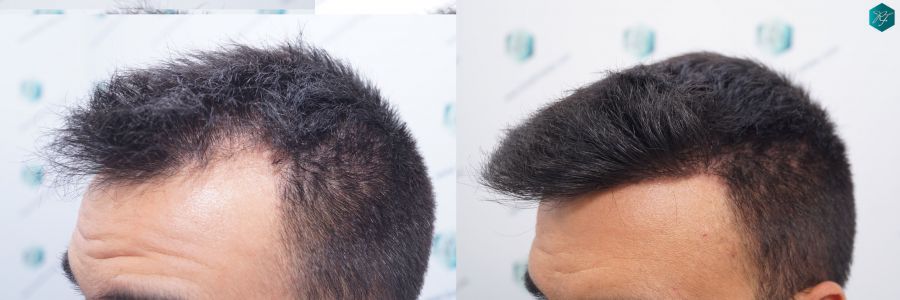 casos reales implante de pelo