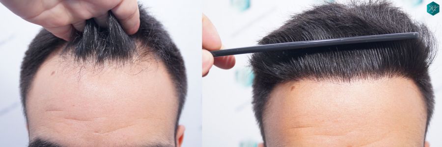 casos reales implante de pelo