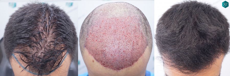 casos reales implante de pelo