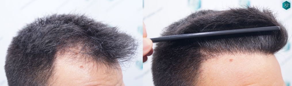 casos reales implante de pelo