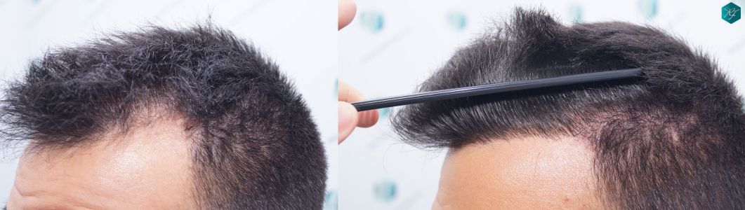 casos reales implante de pelo