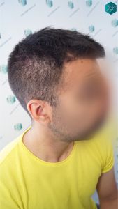INJERTO DE PELO EN VALENCIA