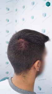 INJERTO DE PELO EN VALENCIA