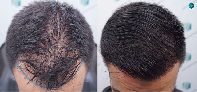 INJERTO DE PELO EN VALENCIA