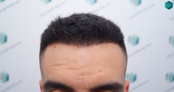 INJERTO DE PELO EN VALENCIA