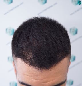 INJERTO DE PELO EN VALENCIA