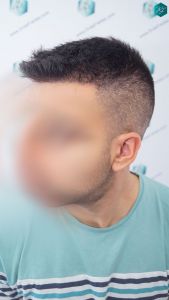 INJERTO DE PELO EN VALENCIA