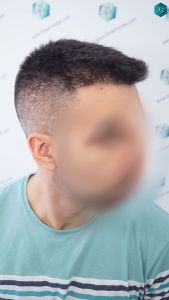 INJERTO DE PELO EN VALENCIA