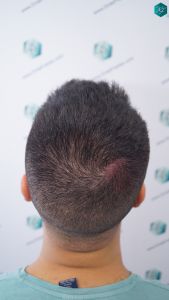 INJERTO DE PELO EN VALENCIA