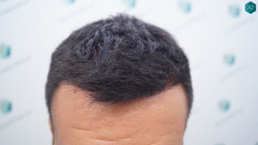 INJERTO DE PELO EN VALENCIA