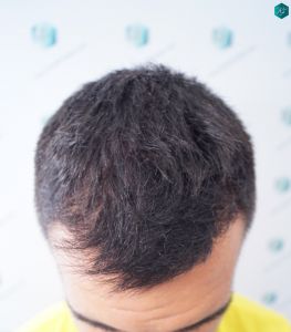 INJERTO DE PELO EN VALENCIA