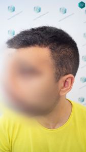 INJERTO DE PELO EN VALENCIA