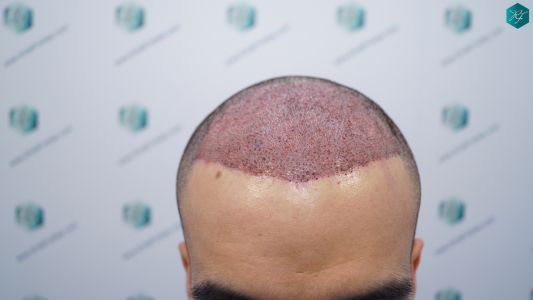 Injerto de pelo en España